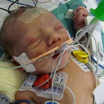 Birth Injury Lack of Oxygen